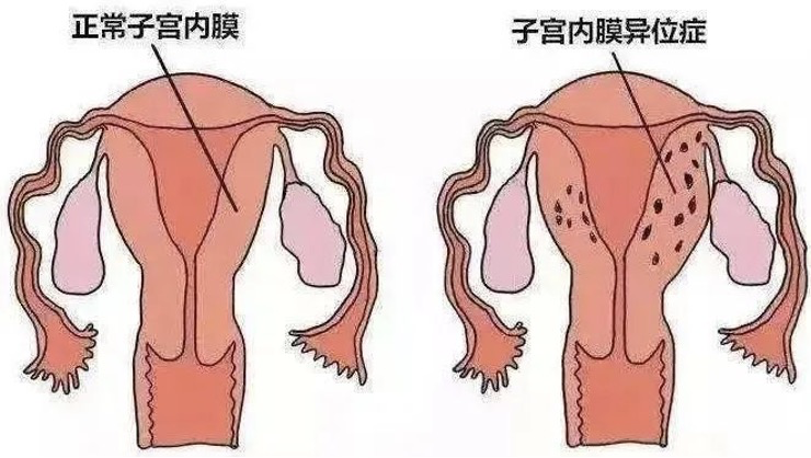 什么是子宫内膜异位症